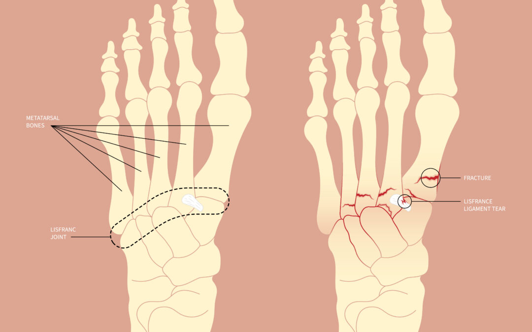 Lisfranc injury chronic pain lawsuit
